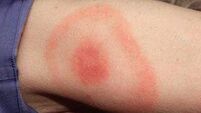 Just a tick — take time to find out about Lyme disease